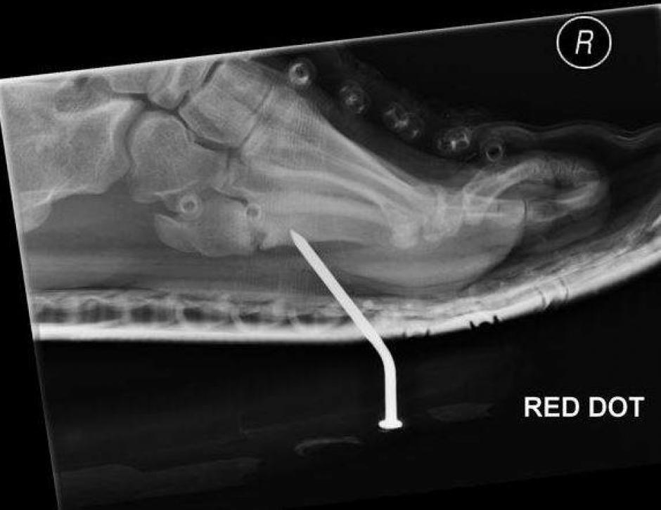 Este paciente se par&oacute; sobre una pedazo de madera que ten&iacute;a un clavo que traspas&oacute; la suela de su zapato y se le clav&oacute; en el pie. (Foto: Radiopaedia)
