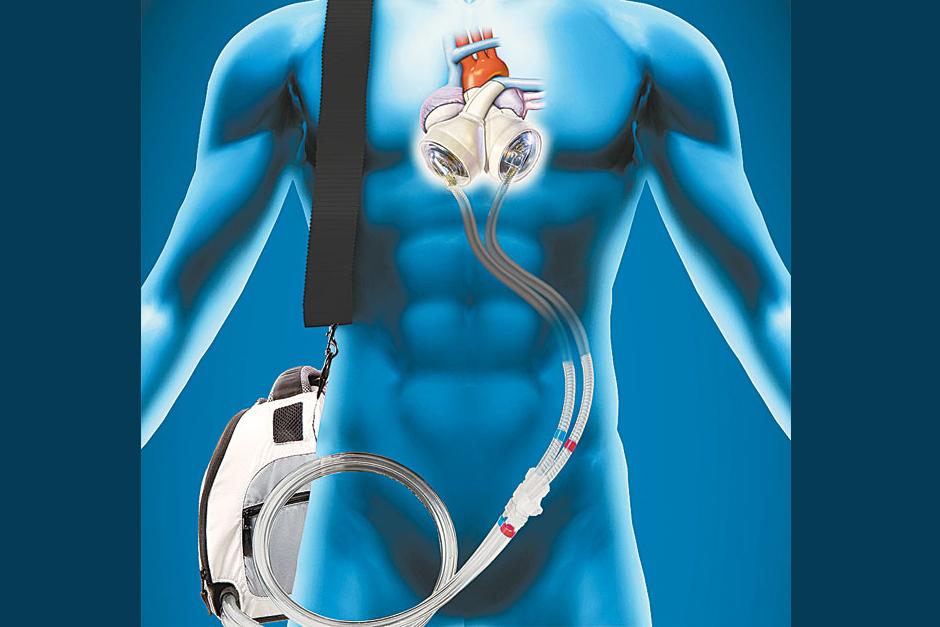 "Estamos muy contentos de ver lo bien que le fue a muchos de estos pacientes", dijo el autor principal del estudio, Swaminatha Gurudevan, cardiólogo del Instituto del Corazón Cedars-Sinai, donde se realizó la investigación de 2012 a 2013. (Foto: Google)