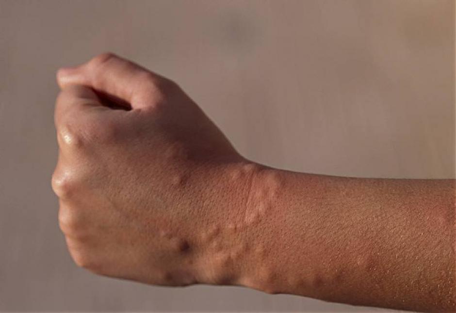 Las molestas picaduras de mosquitos te pueden ayudar a ganar un concurso en Rusia. (Foto:&nbsp;www.elbaixllobregat.net)