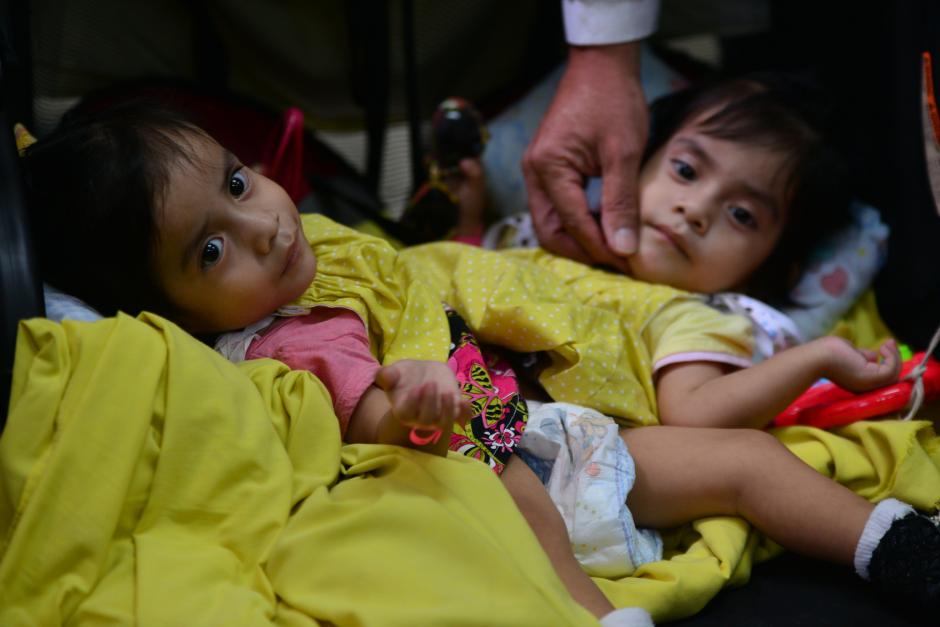 Las siamesas ser&aacute;n separadas durante una intervenci&oacute;n quir&uacute;rgica que podr&iacute;a durar hasta 16 horas. (Foto Wilder L&oacute;pez/Soy502)