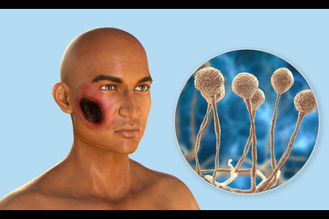 ¿Cómo evitar contagiarme con el hongo negro?