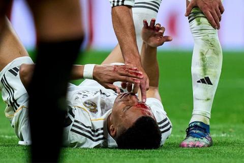 Mbapp&eacute; recibe puntos de sutura en una ceja y no se entrena