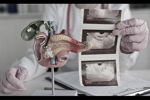 &iexcl;Una nueva esperanza! El prometedor tratamiento para el c&aacute;ncer de p&aacute;ncreas