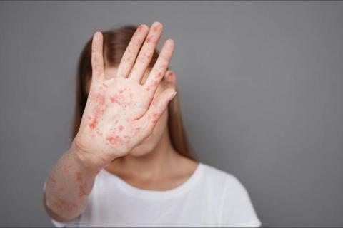 &iexcl;Alerta! Salud reporta m&aacute;s de 6 mil casos de sarampi&oacute;n, 20 v&iacute;ctimas han muerto