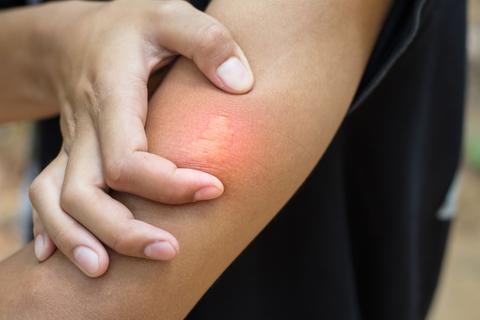 Presta atenci&oacute;n a las picaduras de algunos insectos