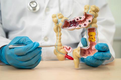 Conoce sobre la enfermedad inflamatoria intestinal