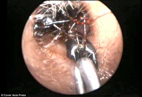 Descubren un nido de hormigas gigantes en el o&iacute;do de una ni&ntilde;a