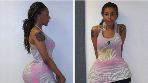 Condenan a la falsa cirujana que inyectaba cemento en los gl&uacute;teos 