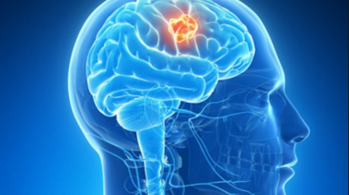 El Zika podr&iacute;a ser eficaz para tratar el c&aacute;ncer cerebral