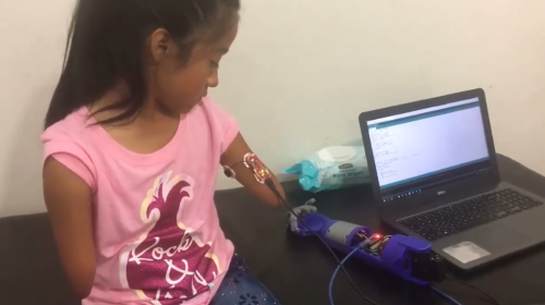 Estudiante guatemalteco crea pr&oacute;tesis 3D para ni&ntilde;a en Quetzaltenango