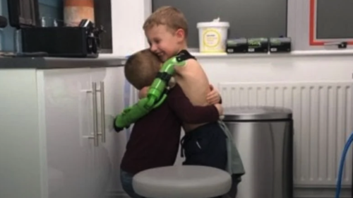 Niño pudo abrazar a su hermano gracias a un brazo biónico 