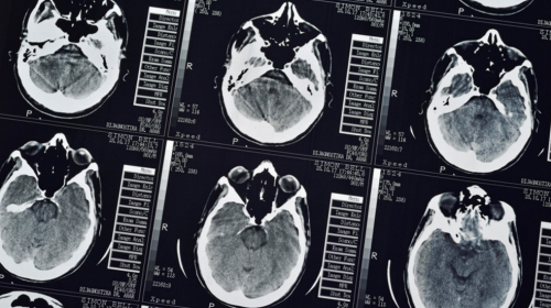 Afirman que los síntomas del alzhéimer se esconden por años 