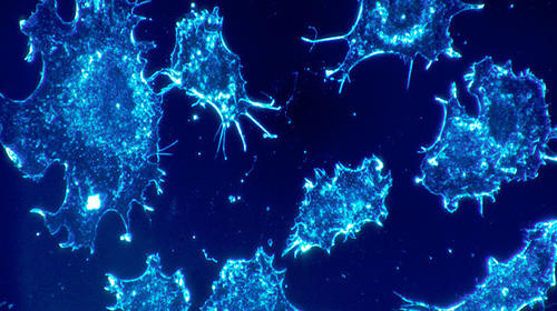 Descubren forma de combatir c&aacute;ncer resistente a la quimioterapia