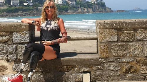 Fue al hospital por una tos y le amputaron las piernas y una mano