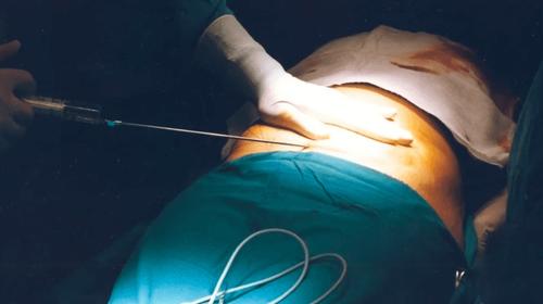 Practicó una mala liposucción, la joven falleció y lo capturaron 